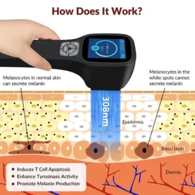 Handheld 308nm UVB Phototherapy Device 49 Diodes Targeted Light Therapy Vitiligo Psoriasis Dermatitis Treatment Rechargeable